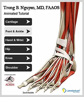 skeletal image of foot, ankle and heel surgery